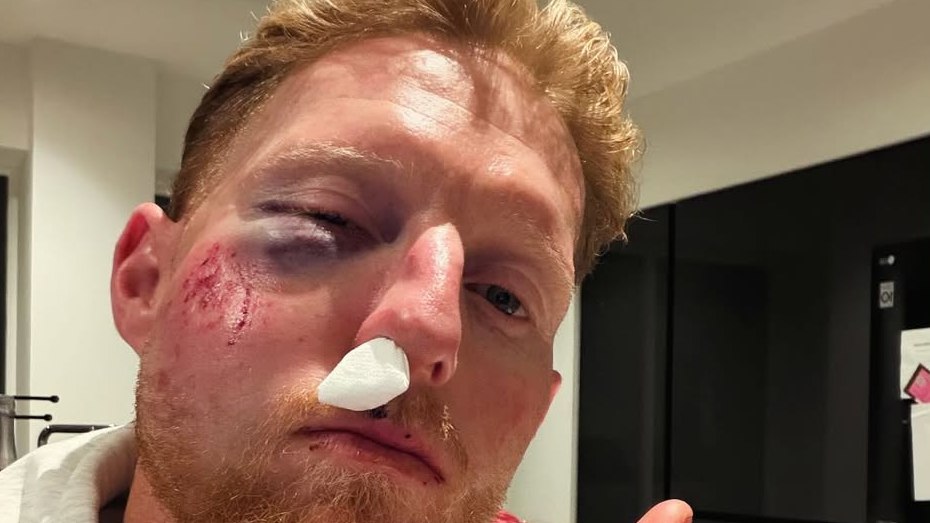Ben Stokes suffers facial injuries after being hit by cricket ball