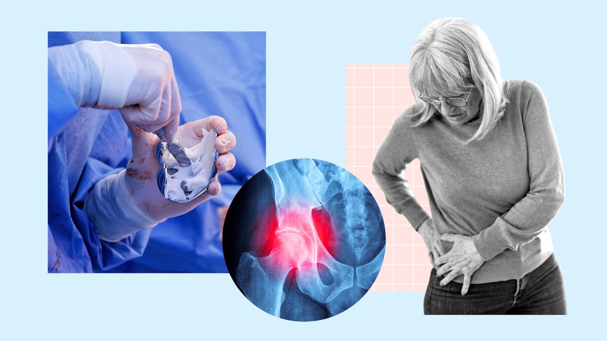 NHS joint replacements get go-ahead amid bone cement shortage