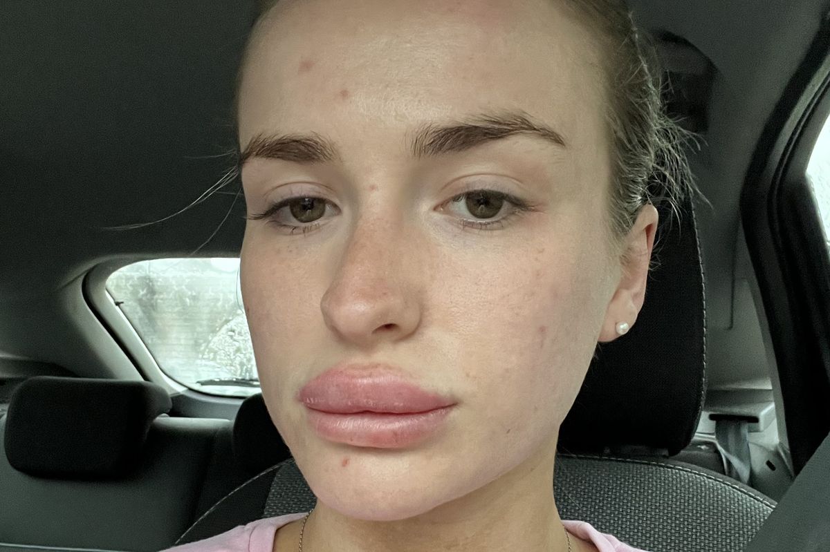 PIC FROM Kennedy News/@lilythompstone (PICTURED: LILY THOMPSTONE, 23, WOKE UP TO FIND HER LIPS HAD SWELLED UP) A woman claims her entire body broke out in a horrific rash due to the STRESS of doctors not taking her illness seriously. Lily Thompstone said she has 'always' suffered with gut issues and was often sick after meals but doctors put it down to IBS and she was continually left in 'discomfort'. Things took a sudden when the 23-year-old woke up with 'humongous' lips in May 2023 and rushed to A&E where she was given steroids to bring down the swelling. DISCLAIMER: While Kennedy News and Media uses its best endeavours to establish the copyright and authenticity of all pictures supplied, it accepts no liability for any damage, loss or legal action caused by the use of images supplied and the publication of images is solely at your discretion. SEE KENNEDY NEWS COPY - 0161 697 4266