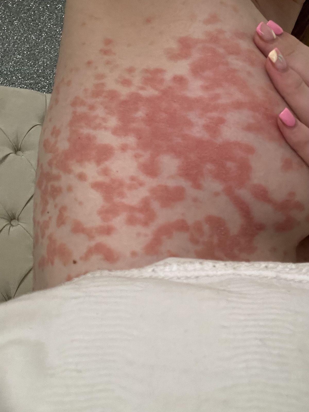 PIC FROM Kennedy News/@lilythompstone (PICTURED: LILY THOMPSTONE'S RASH COVERING MOST OF HER BODY) A woman claims her entire body broke out in a horrific rash due to the STRESS of doctors not taking her illness seriously. Lily Thompstone said she has 'always' suffered with gut issues and was often sick after meals but doctors put it down to IBS and she was continually left in 'discomfort'. Things took a sudden when the 23-year-old woke up with 'humongous' lips in May 2023 and rushed to A&E where she was given steroids to bring down the swelling. DISCLAIMER: While Kennedy News and Media uses its best endeavours to establish the copyright and authenticity of all pictures supplied, it accepts no liability for any damage, loss or legal action caused by the use of images supplied and the publication of images is solely at your discretion. SEE KENNEDY NEWS COPY - 0161 697 4266