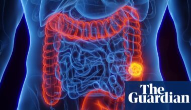 What is colorectal cancer and is it preventable? | Well actually