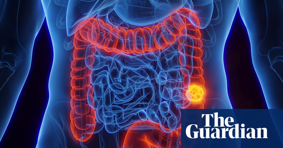 What is colorectal cancer and is it preventable? | Well actually