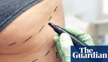 Brazilian butt lifts should be banned in UK amid ‘wild west’ industry, MPs say | Health
