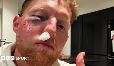 A photo of England Test captain with a black eye and injured nose after being hit by a cricket ball while coaching, with the caption "You should see the state of the cricket ball"
