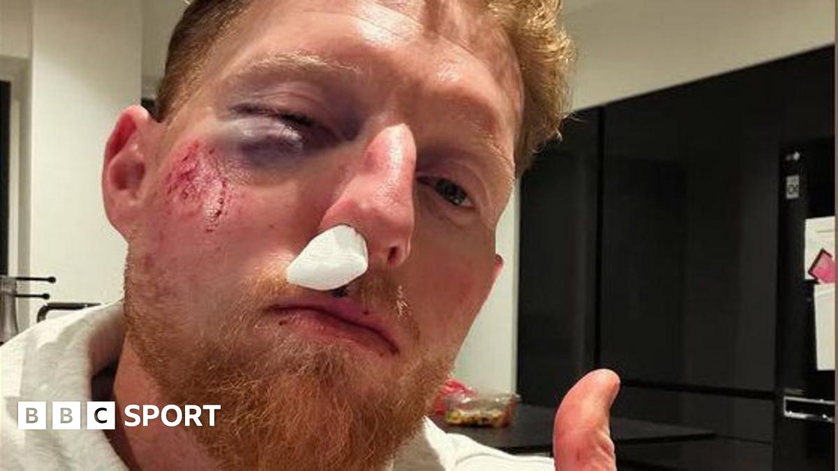 A photo of England Test captain with a black eye and injured nose after being hit by a cricket ball while coaching, with the caption "You should see the state of the cricket ball"