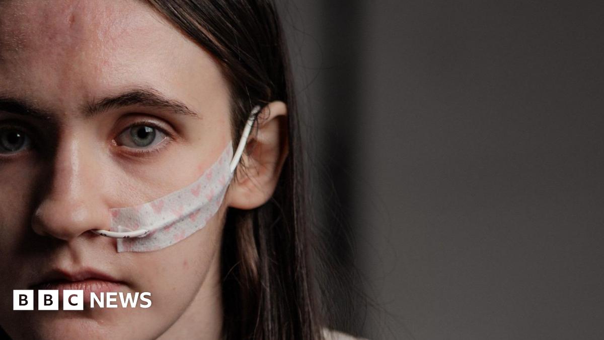 Young woman with dark hair and a nasogastric tube