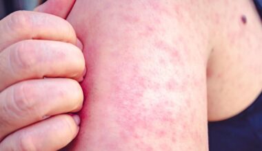 Victorian disease outbreak rocks major city sparking World Cup warning | World | News