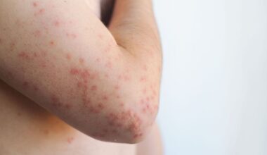 ‘Potentially deadly’ disease spreads across UK and Europe - 26 hotspots named | UK | News