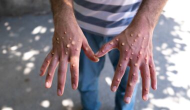 Warning issued as cases of deadly virus increase in 2 UK areas | UK | News