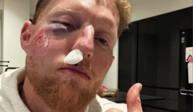 Ben Stokes shares snap of shocking facial injuries after being struck with cricket ball in training