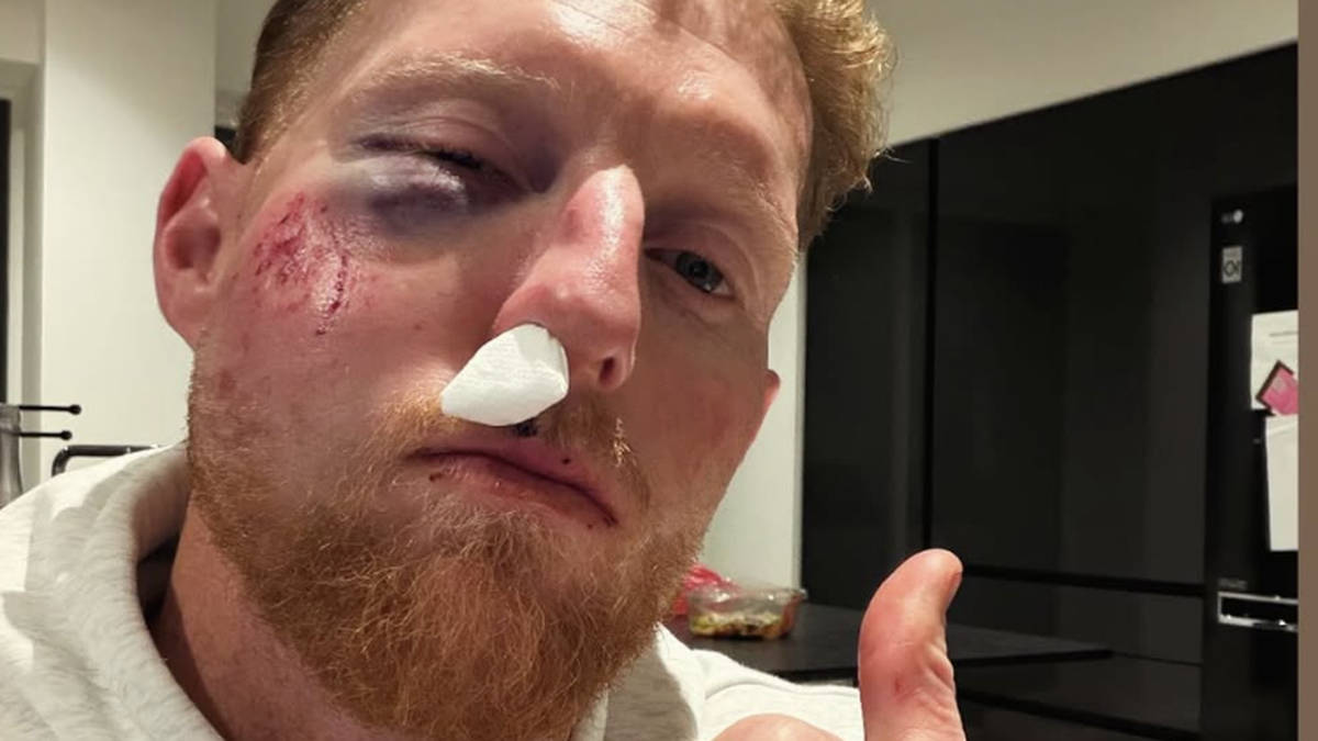 Ben Stokes shares snap of shocking facial injuries after being struck with cricket ball in training
