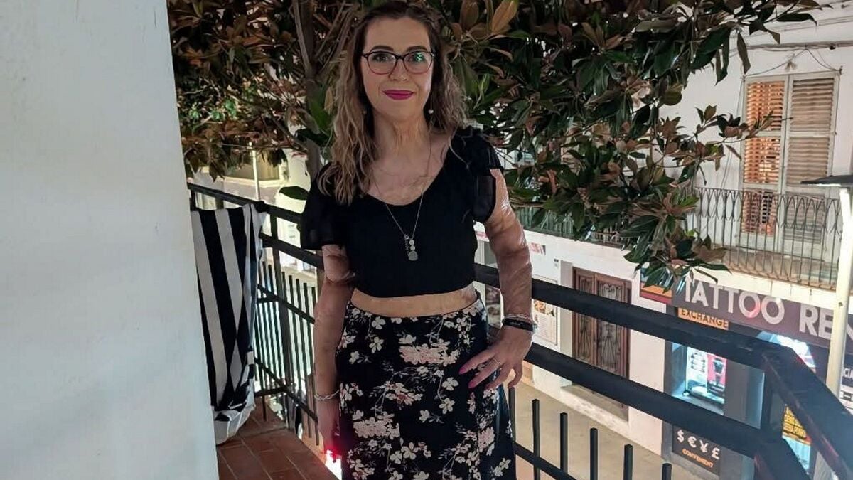 ‘My parents were told I wouldn’t survive’: NI woman opens up on her journey after suffering severe burns as a child