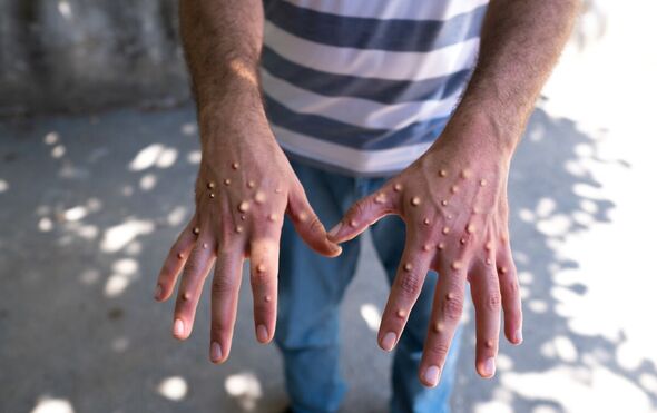 A man with mpox holds out his hands which appear covered with blisters