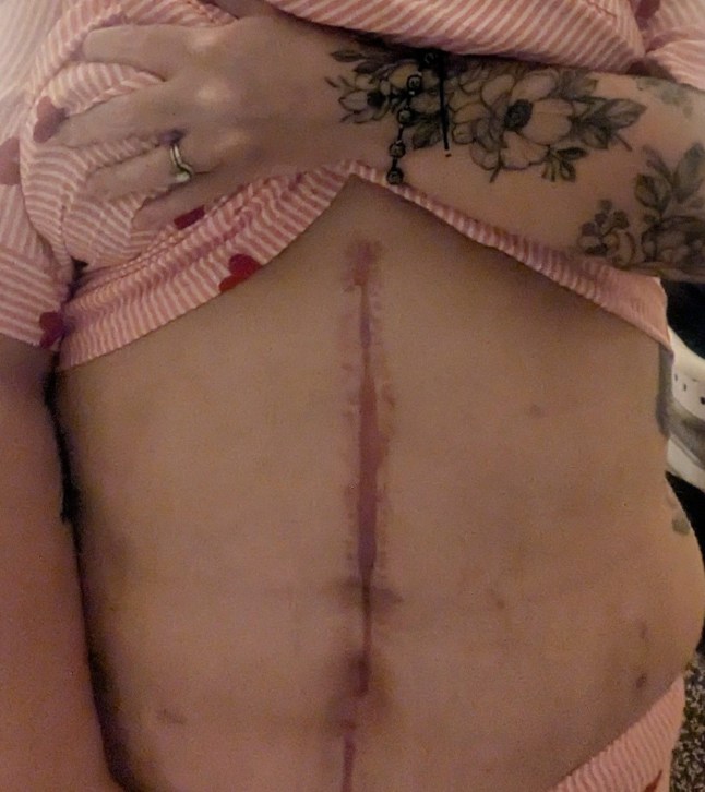 Becki Ward's surgery scar. A woman who thought she couldn?t lose weight on Mounjaro because she was ?lazy?, actually had a 12kg tumour growing inside her. Becki Ward, 33, decided to start weight loss jabs after struggling to shift the pounds naturally, but was confused as they didn?t seem to be working. After starting to get stomach pains and night sweats, the Trainee Education Mental Health Practitioner, from Great Yarmouth, Norfolk, went to the doctors, and after five months of tests was finally diagnosed with pseudomyxoma peritonei, an extremely rare form of mucinous cancer. Following the diagnosis, Becki?s stomach continued to grow so large it looked like she was having twins, and in August 2025, she had surgery to remove a 12kg tumour, as well as removing some of her organs, and having a full hysterectomy, plunging her into early menopause. Photo released 12/02/2026