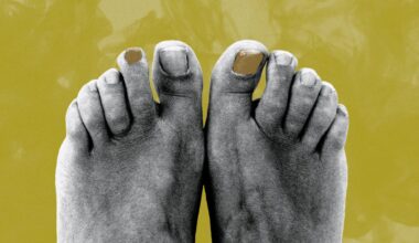 The new cure for a very hard-to-treat (and gross) toenail problem