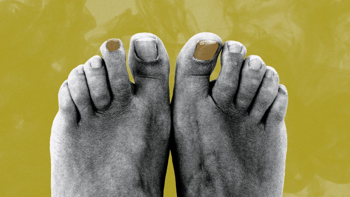 The new cure for a very hard-to-treat (and gross) toenail problem