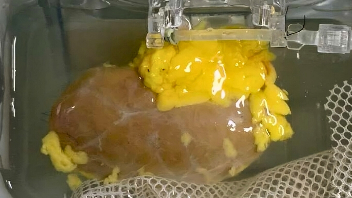 Scientists Created a 'Universal' Kidney To Match Any Blood Type : ScienceAlert