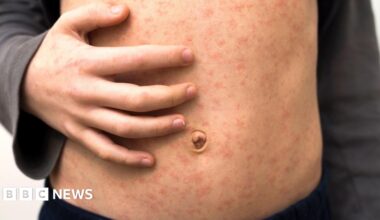 A child with a measles rash on their chest