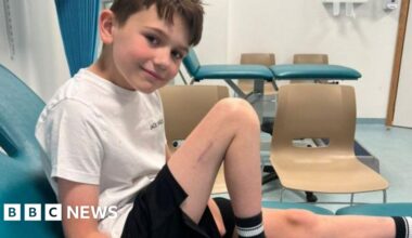 Alder Hey pioneers treatment to make boy taller - BBC