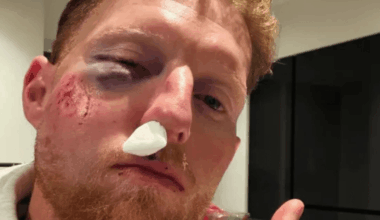 Ben Stokes left with horror facial injuries after England star hit by cricket ball during training