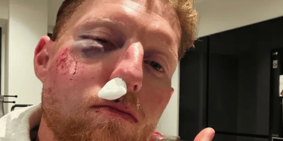 Ben Stokes left with horror facial injuries after England star hit by cricket ball during training