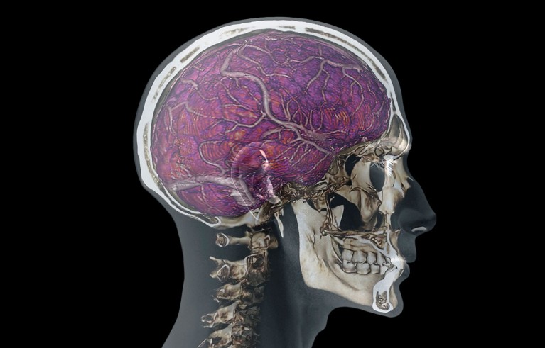 Coloured composite image of an MRI scan of the brain combined with 2D and 3D CT scans of the head and neck of a 35 year old patient.