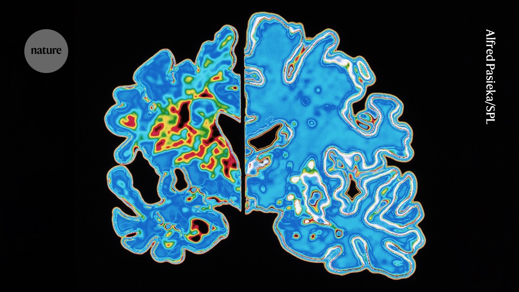 Blood test holds promise for predicting when Alzheimer’s symptoms will start