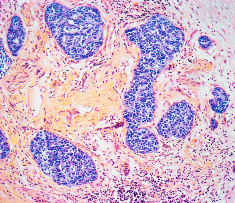 A light micrograph of chronic pancreatitis shown in blobby purple and pink colours