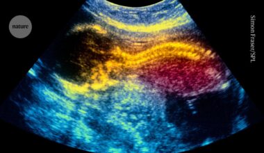 World-first stem-cell therapy shows promise for treating spina bifida in the womb