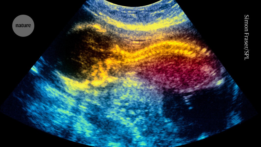 World-first stem-cell therapy shows promise for treating spina bifida in the womb