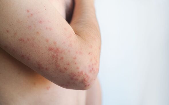 Fine red itchy rash on a mans body after viral infection with irritated and inflamed skin visible in video.