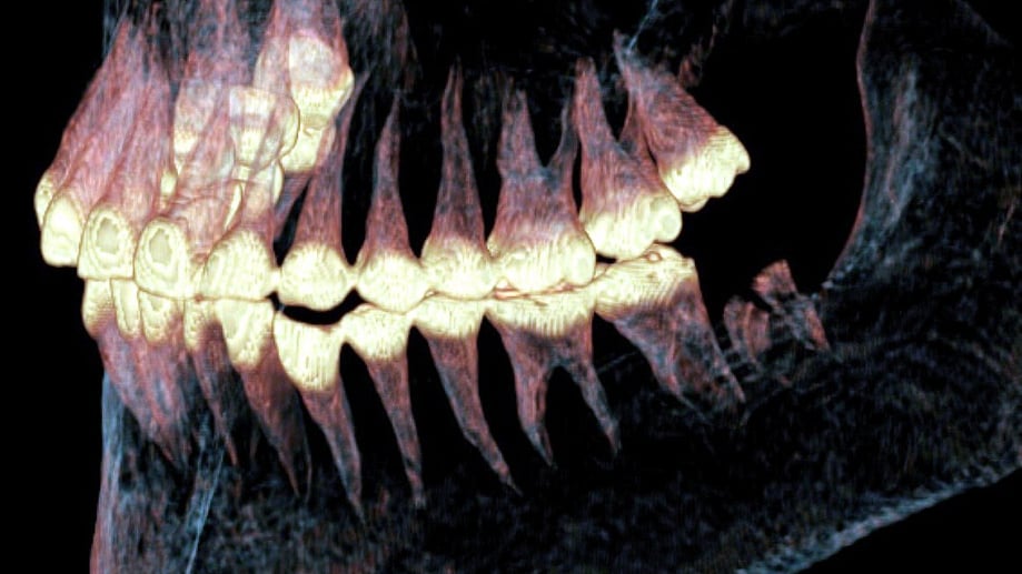 Jaw Prosthetic Pazyryk Side Scan