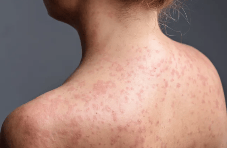 Measles outbreak hits north London schools as dozens of children infected - London Evening Standard