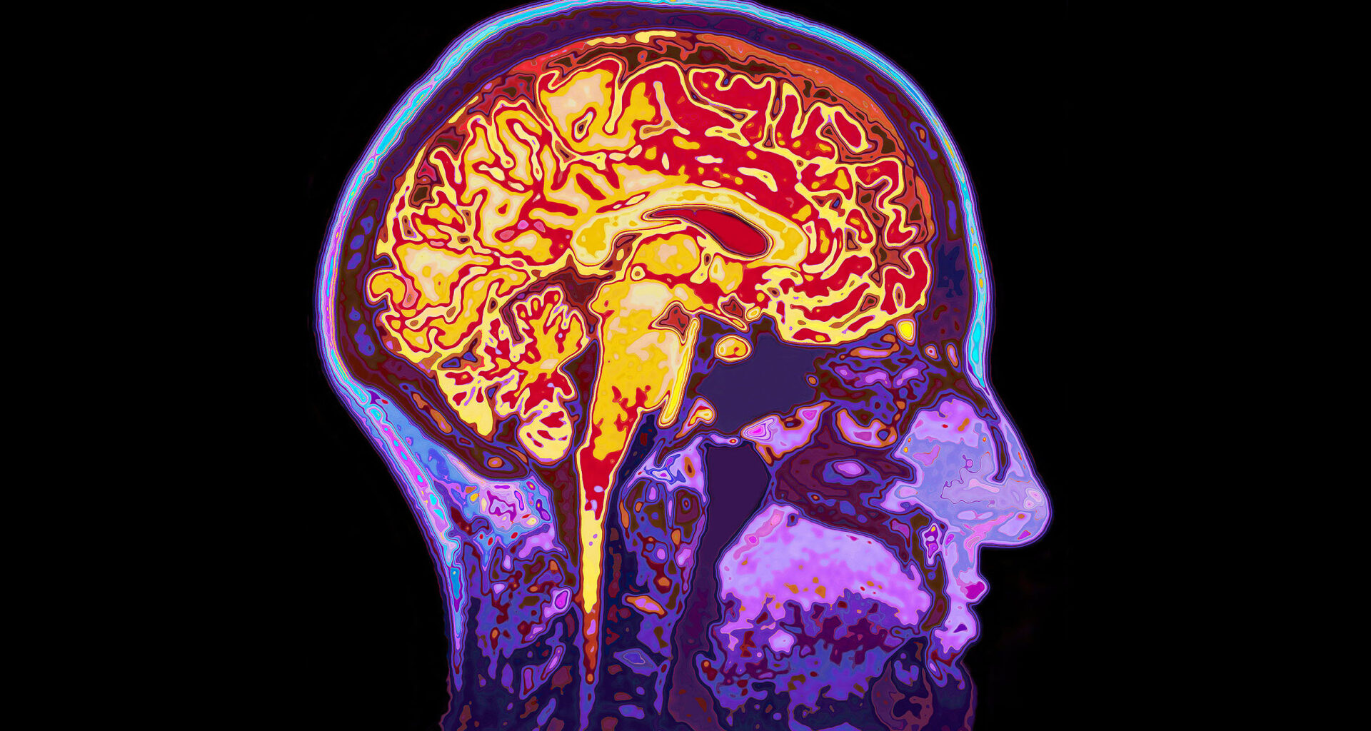 Microplastic accumulation found in brains of dementia patients