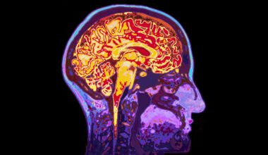 Microplastic accumulation found in brains of dementia patients