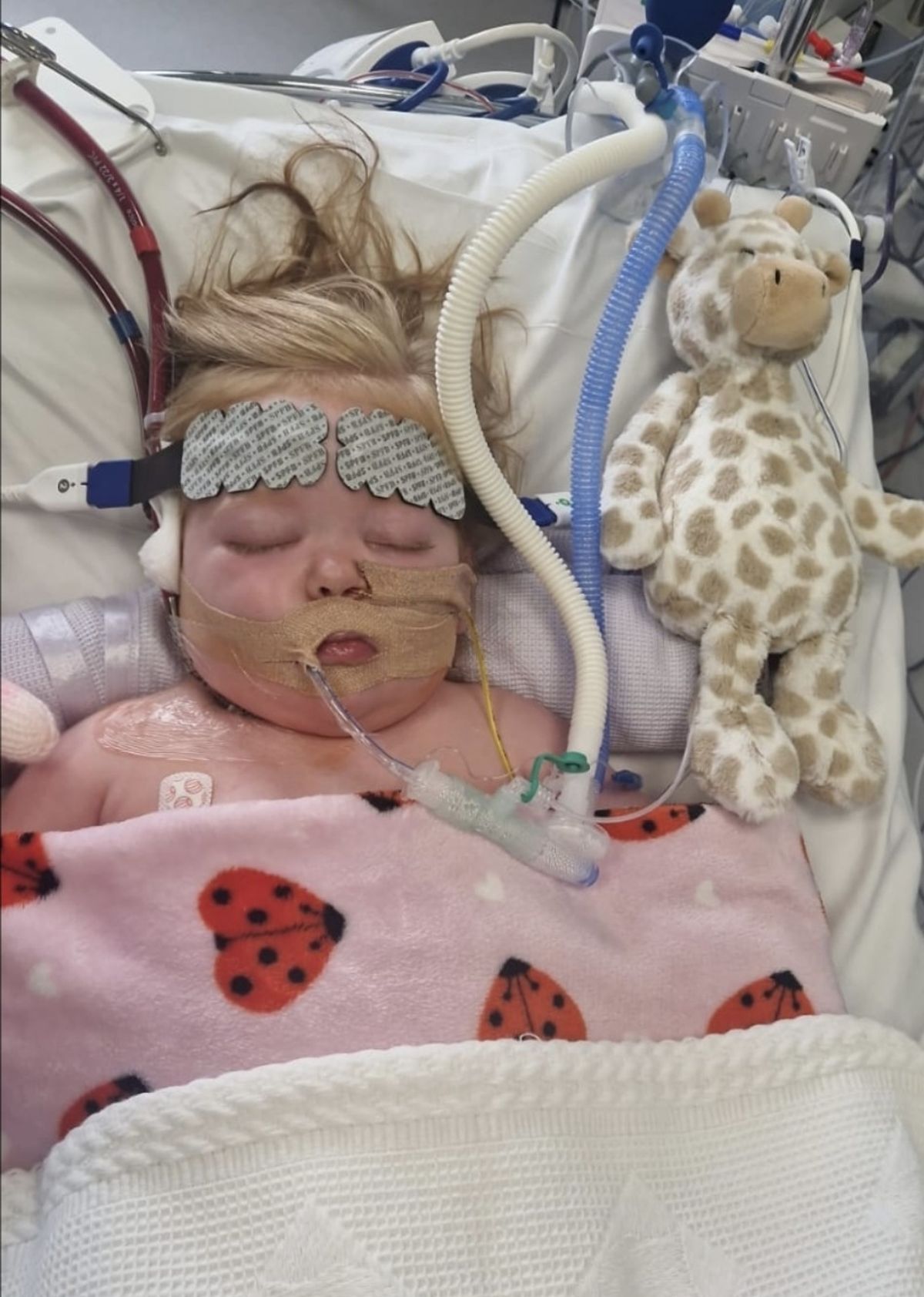 Haisleigh, 2, pictured while in hospital fighting meningococcal sepsis.