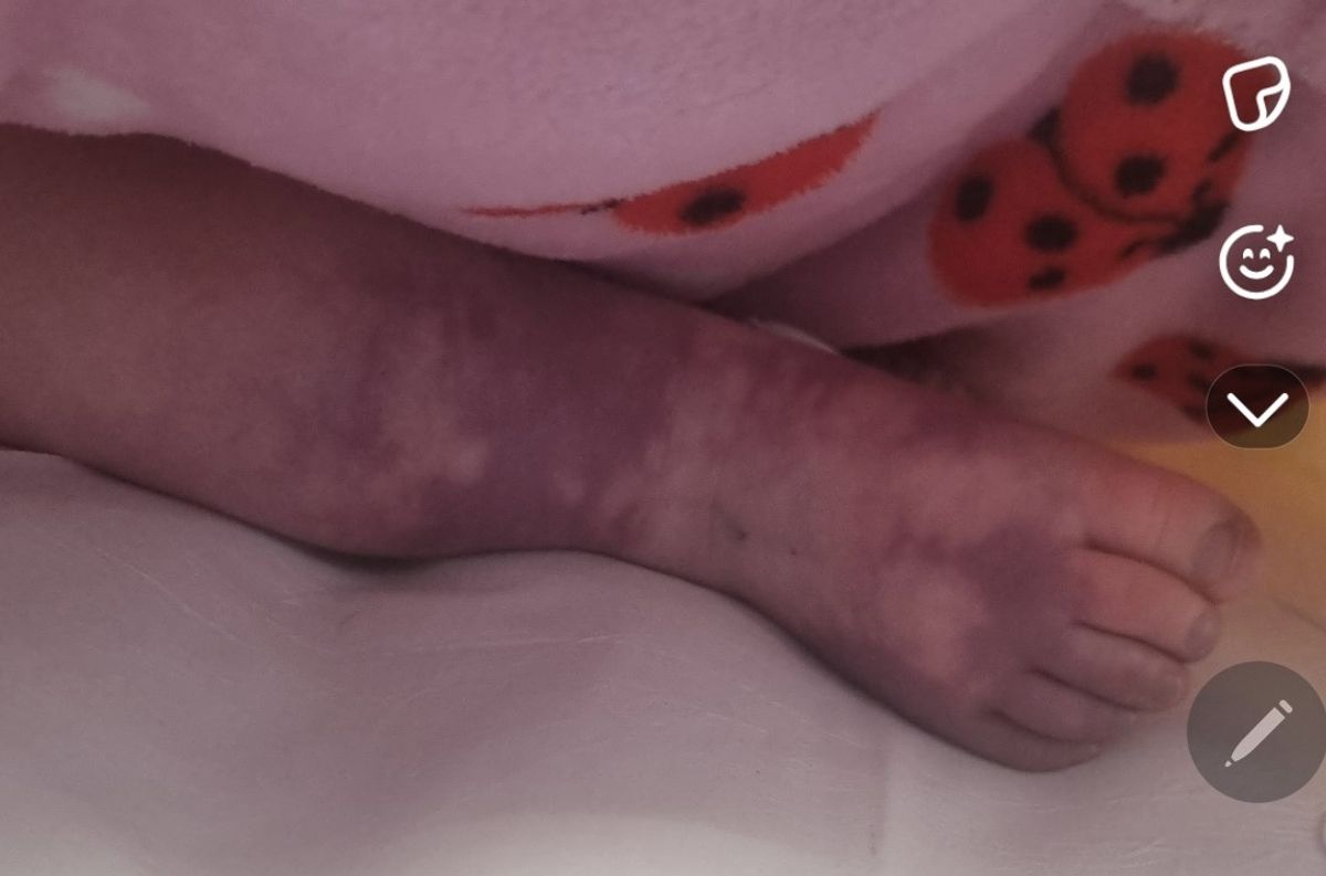 Haisleigh Finlay's mottled legs as she fell ill with meningococcal sepsis.