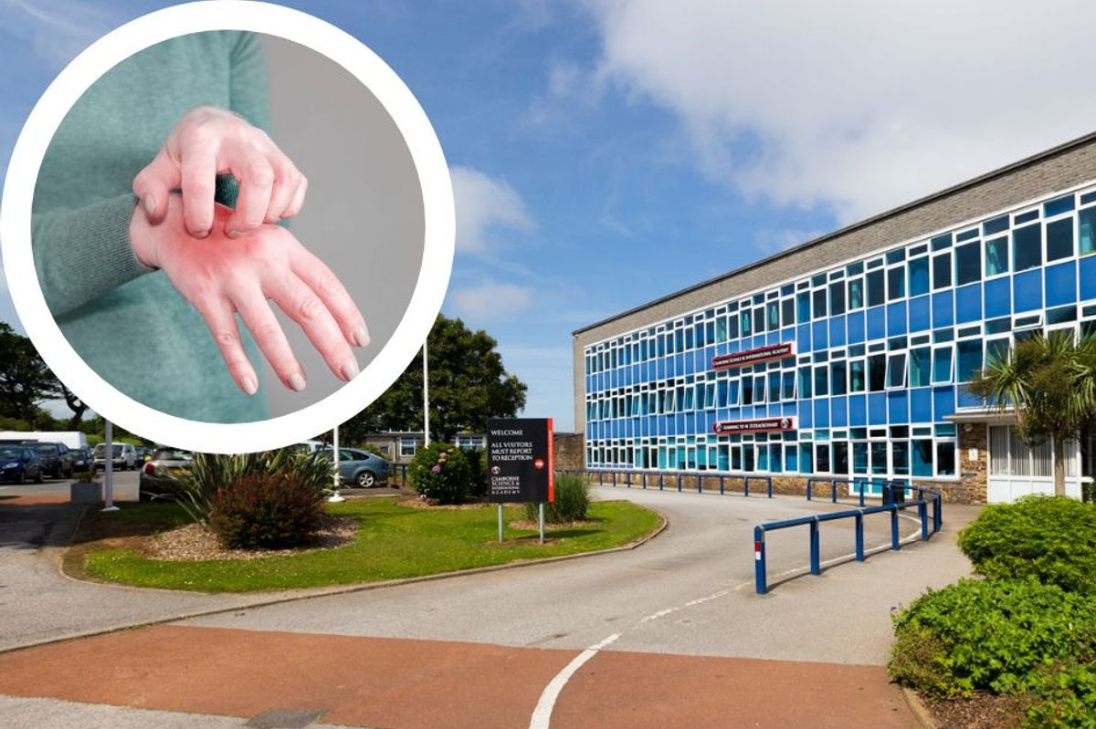 Camborne Science & International Academy has reported a small outbreak of scabies 