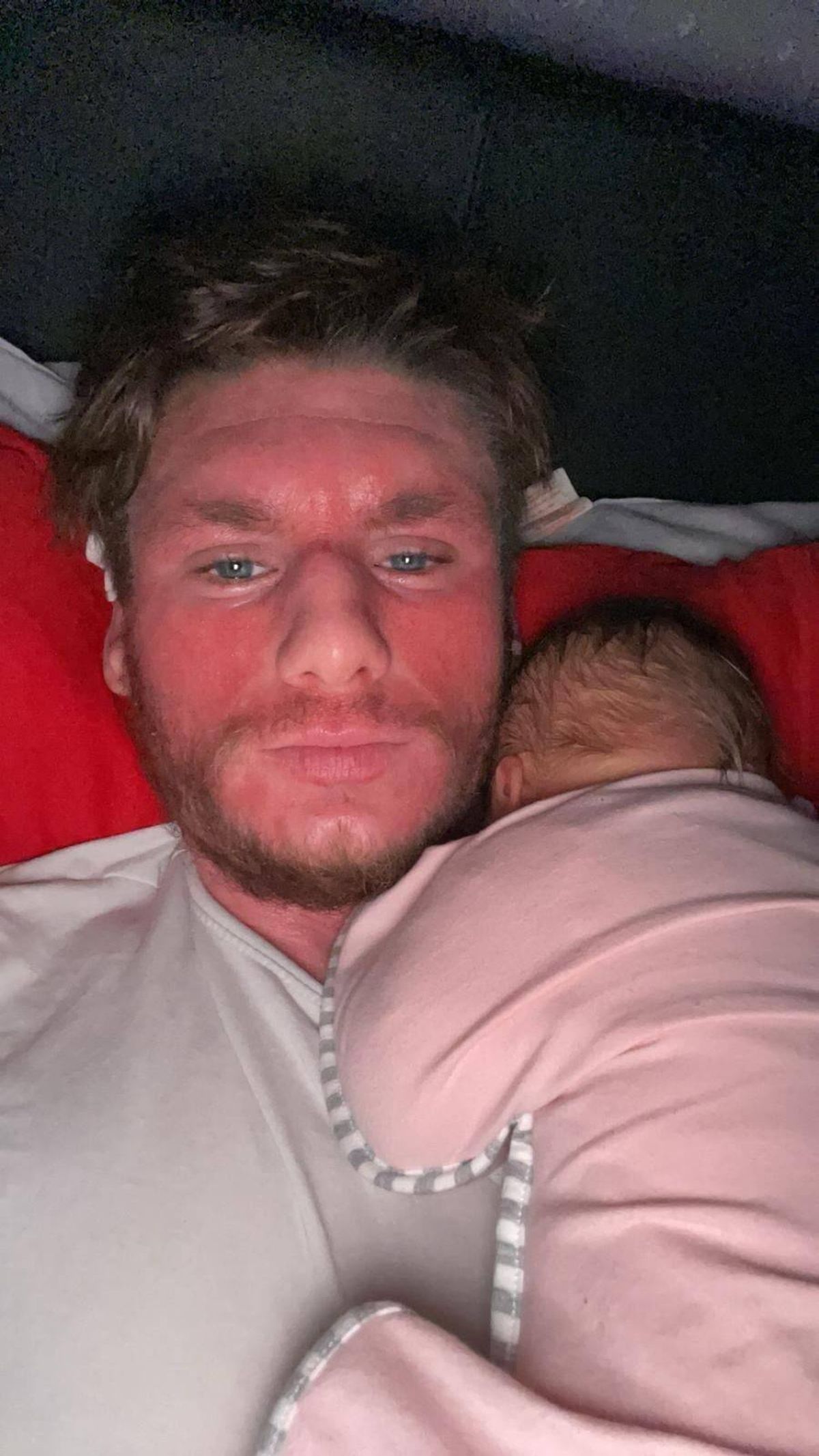 Callum lies on a bed with his baby daughter on his shoulder. He appears with a very red, blistered face