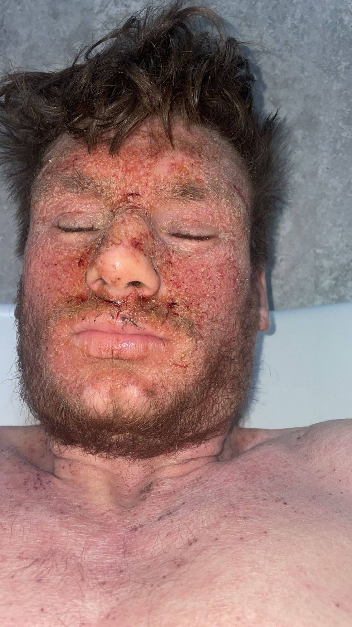 Callum seen with his eyes closed and the skin on his face and upper body flaking