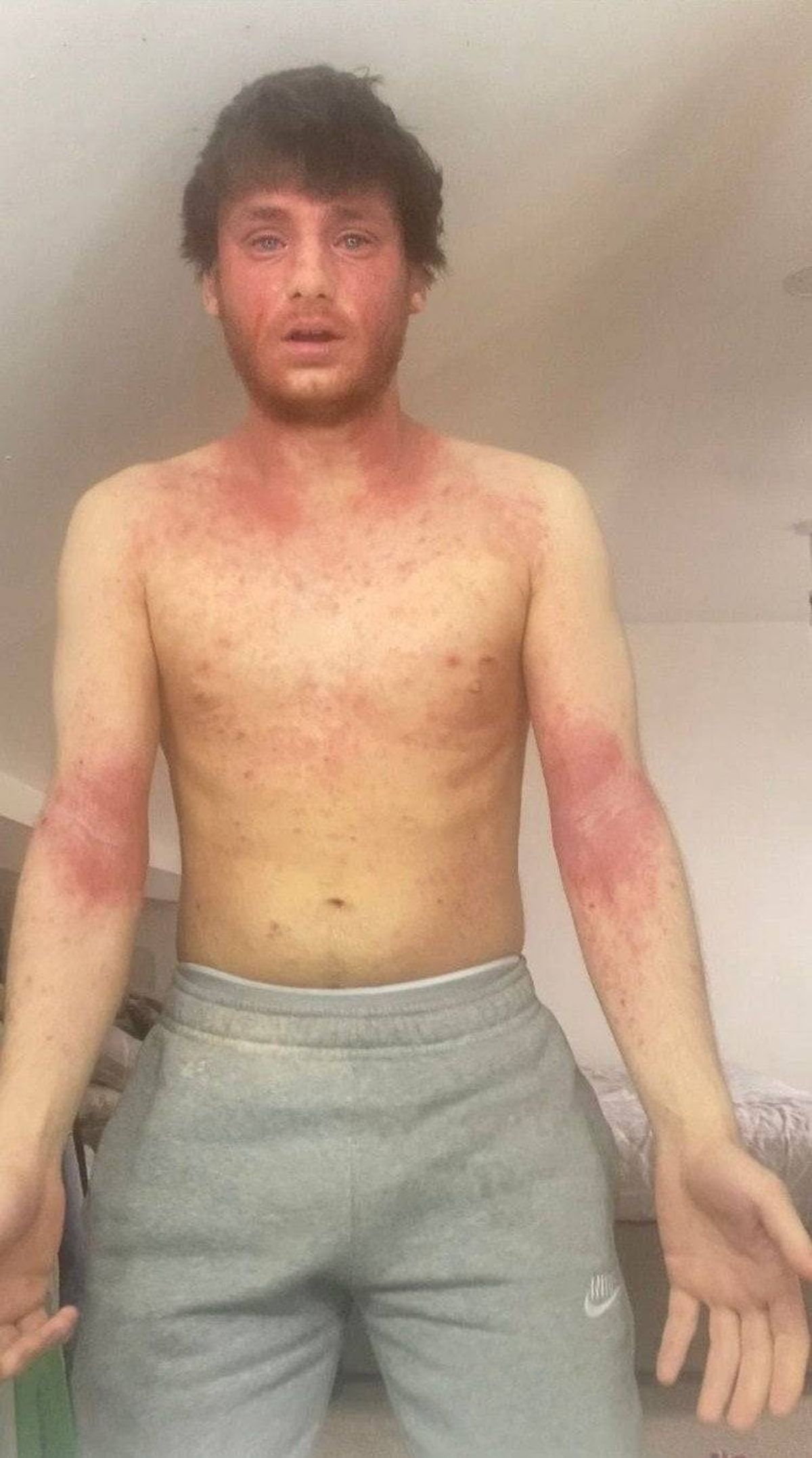 Callum displays a rash on his torso and both arms