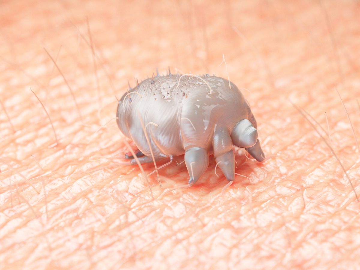 Illustration of a scabies mite on human skin.