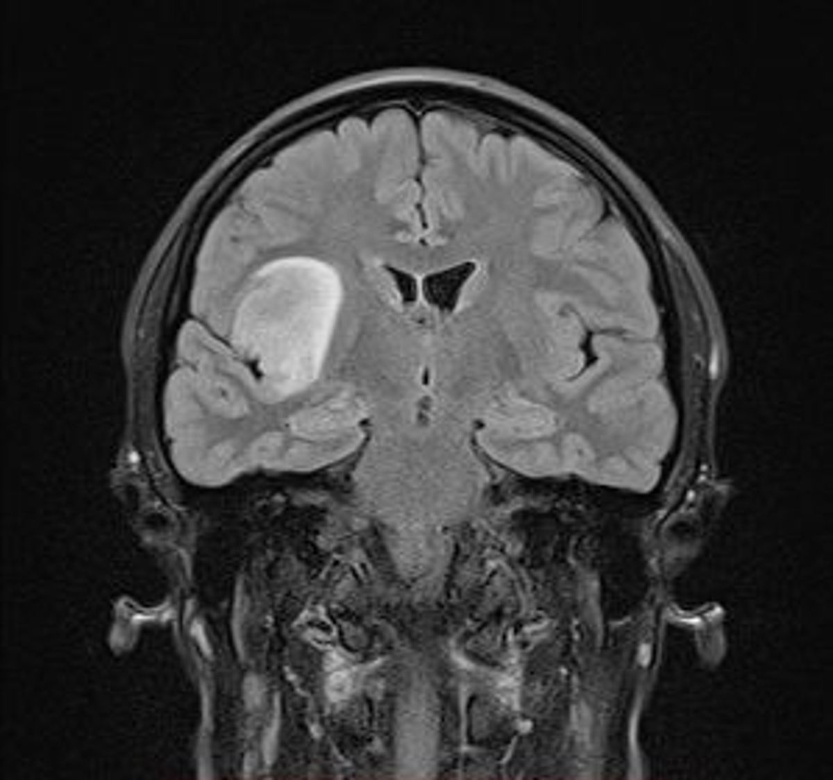 An x-ray of Leah's brain showing the tumour