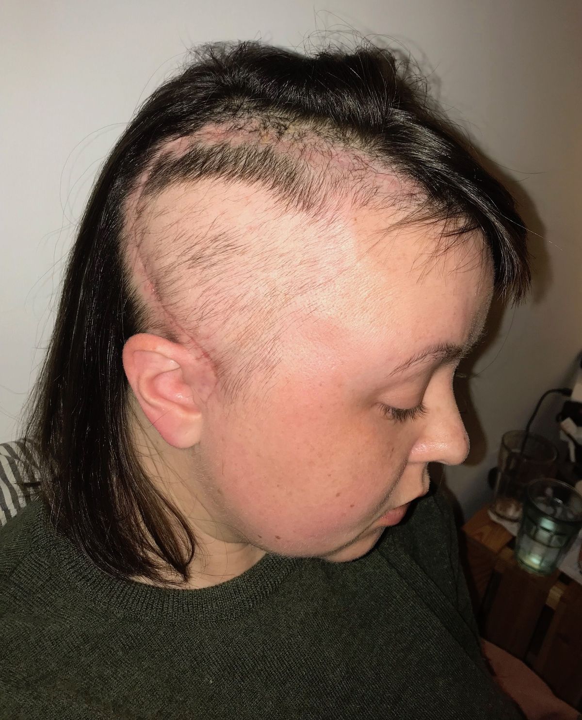 Leah's head after her hair brain operation