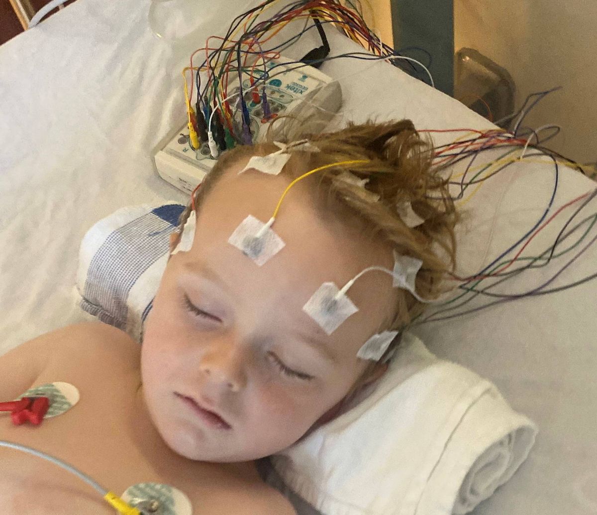 A young individual is lying in a hospital bed, connected to various medical devices. The person's head is adorned with electrodes, suggesting the monitoring of brain activity, while a medical tube is attached to their chest. The individual appears to be in a state of rest, lying comfortably on a pillow.