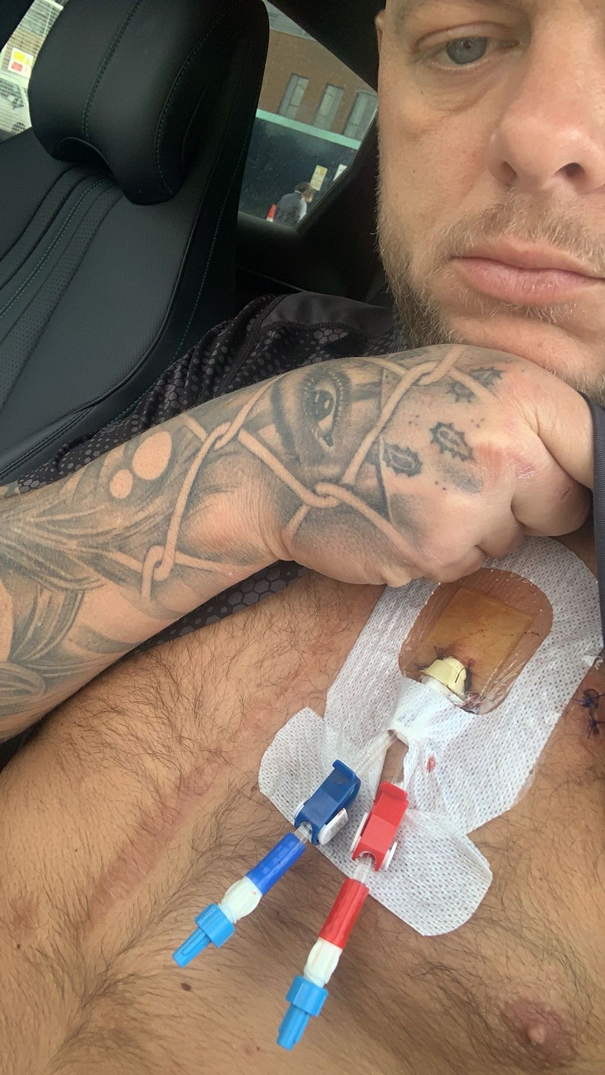 Darren has to have kidney dialysis five times a week