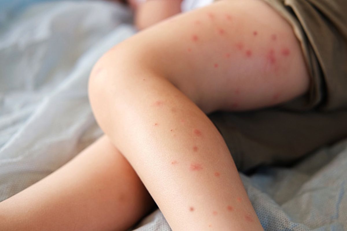 The measles case was recorded by NHS Grampian