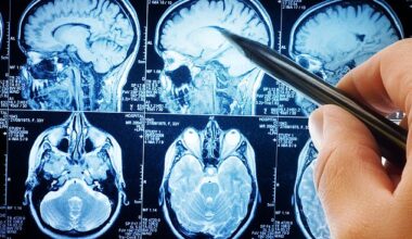 Parkinson's is a degenerative brain disease that affects physical movement and brain function