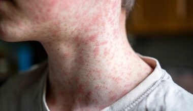 Measles induces a blotchy rash (above) and flu-like symptoms