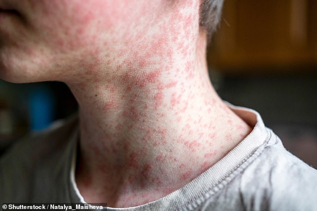 Measles induces a blotchy rash (above) and flu-like symptoms